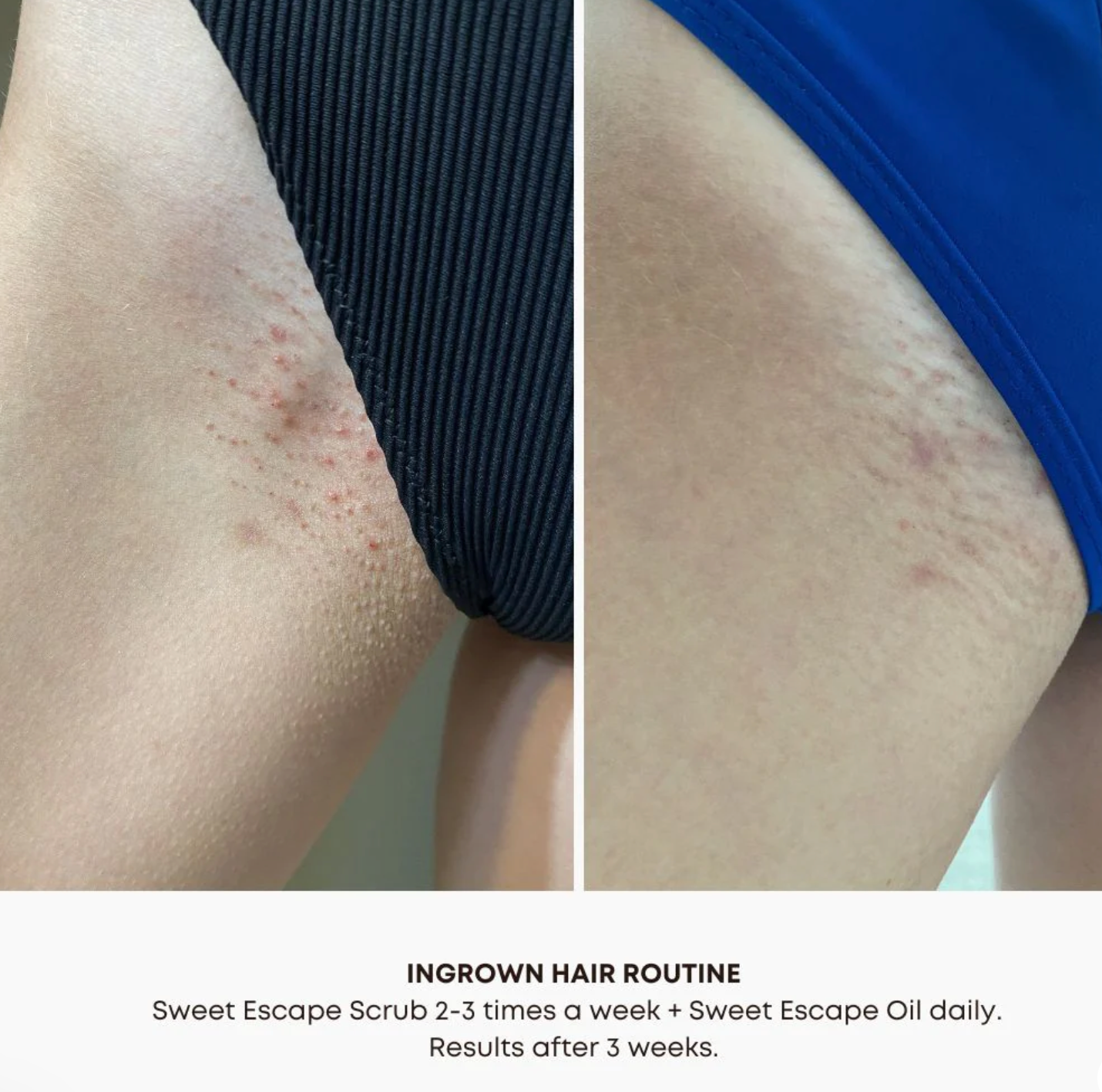 Bushbalm Ingrown Hair Oil image 4
