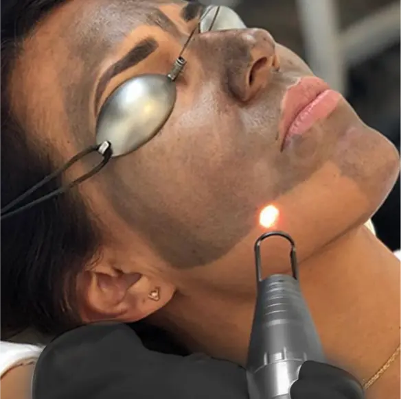 Carbon laser peel