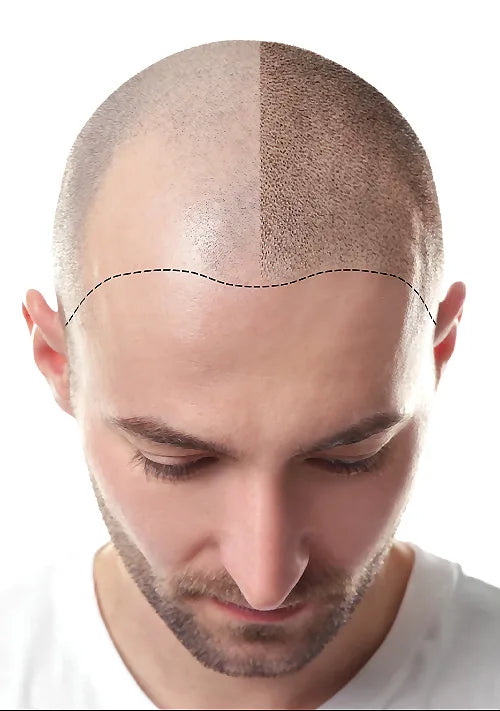Scalp micropigmentation