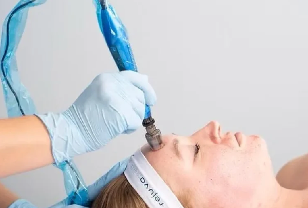 Microneedling